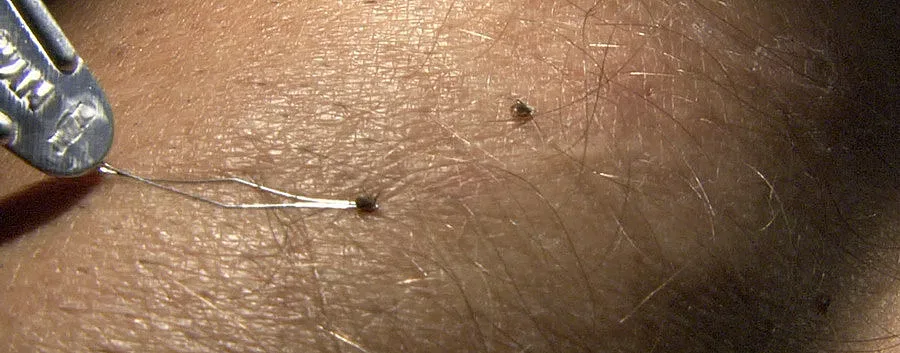 Колко струва да ти махнат кърлеж в болница