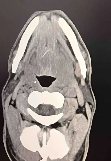 Рибена кост едва не уби мъж от Пловдив