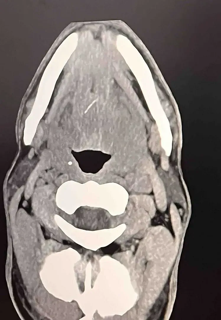 Рибена кост едва не уби мъж от Пловдив