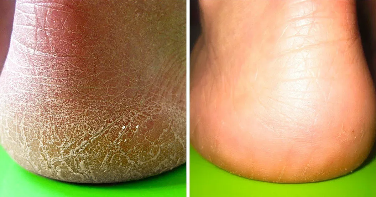 Напукани пети! Как да се справим с този проблем