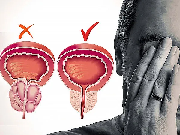 Увеличаването на простатата е зависимо от възрастта