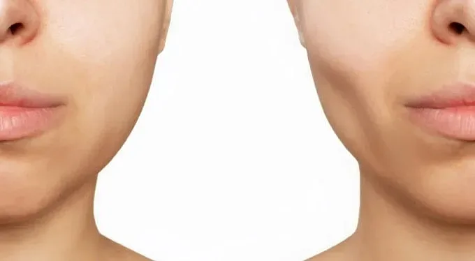 Премахването на мазнини от бузите е новата бюти мода