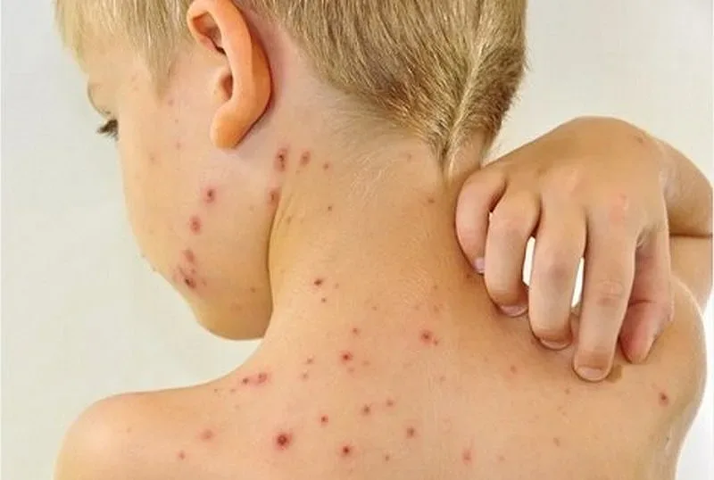 Ужас! Страшна болест се завръща! Откриха я близо до нас