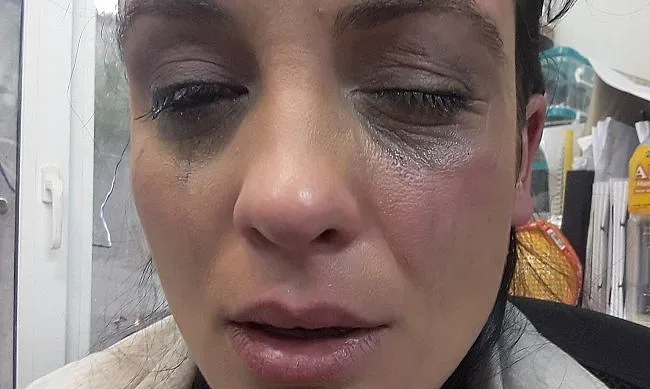 Травми или грим? Ответен удар от Диана Димитрова